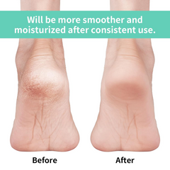 Silicone Gel Heel Socks – Cracked Heels Remedy | Velvet Wheels