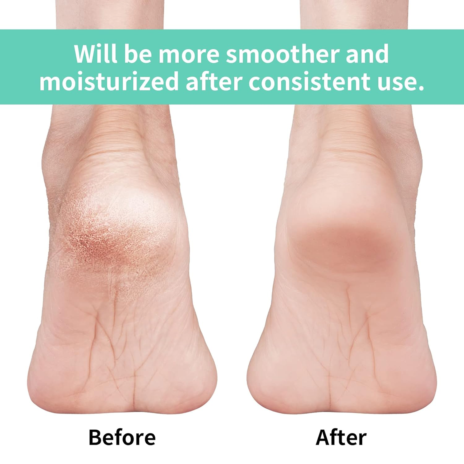 Silicone Gel Heel Socks – Cracked Heels Remedy | Velvet Wheels